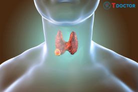 Ung thư tuyến giáp: Hiểu biết về bệnh ung thư tuyến giáp phổ biến nhất